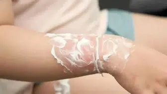 Kış Aylarında Artan Yanık Vakalarına Karşı Sağlık Uzmanlarından Uyarı!