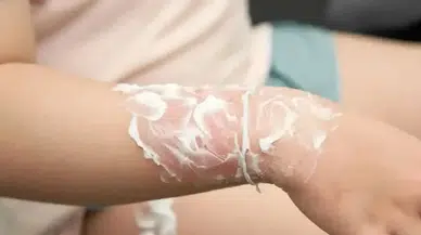 Kış Aylarında Artan Yanık Vakalarına Karşı Sağlık Uzmanlarından Uyarı!